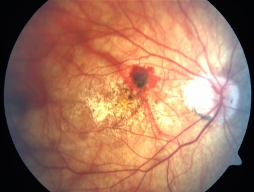 Image result for myopic choroidal neovascularization