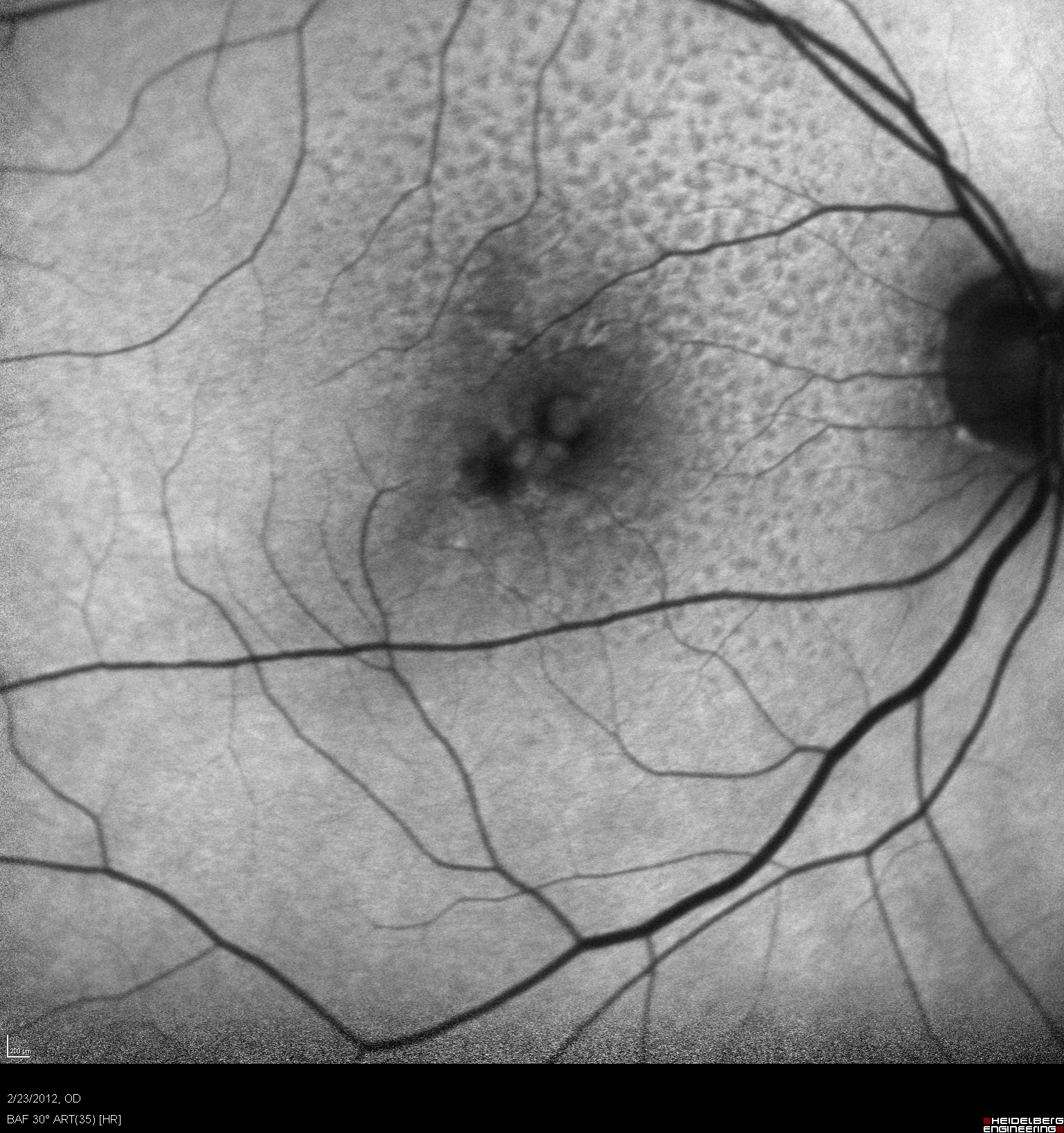 Macular Drusen Right Eye Icd 10