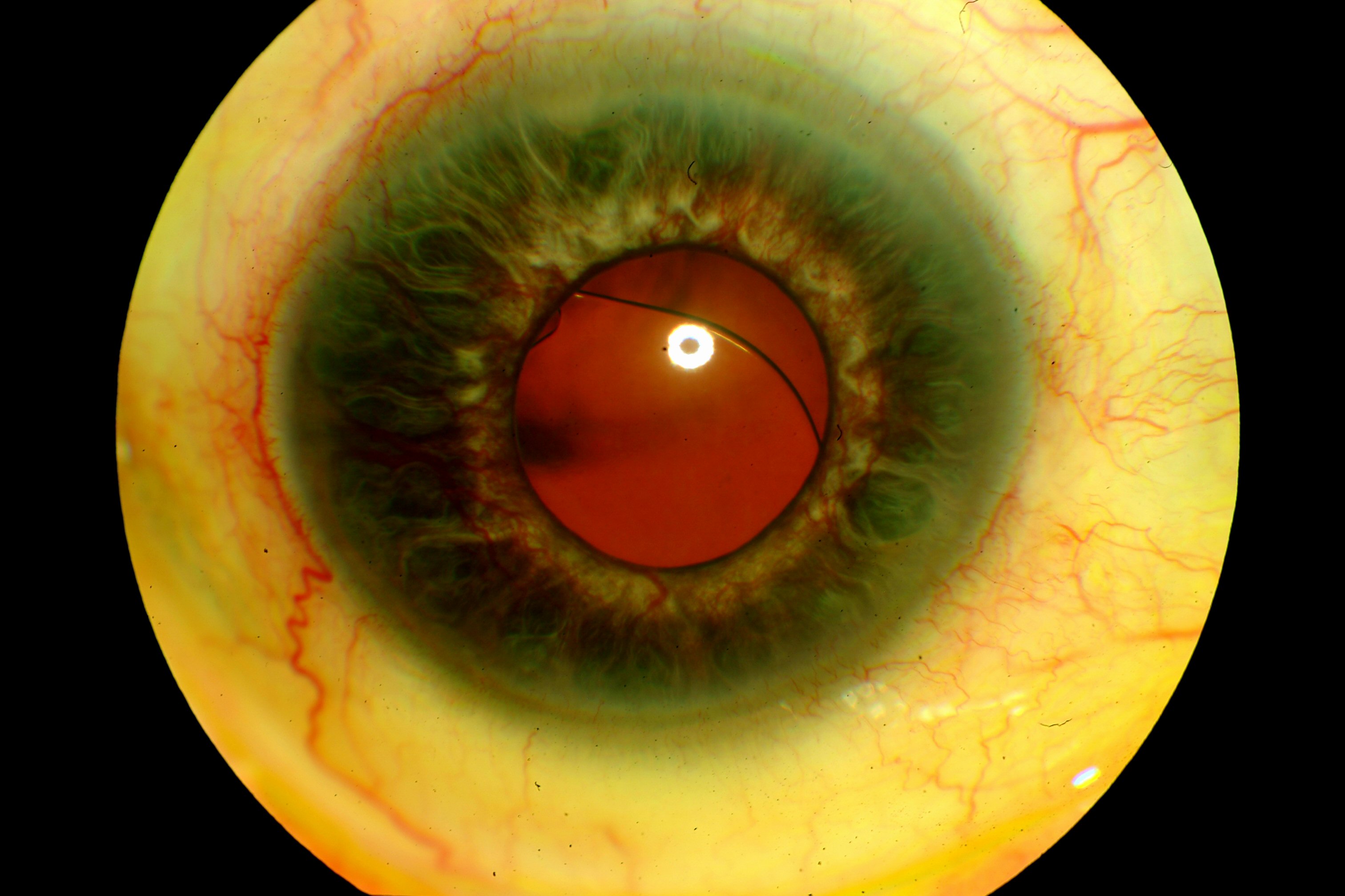 April 2013 - Iris Neovascularization secondary to Central Retinal
