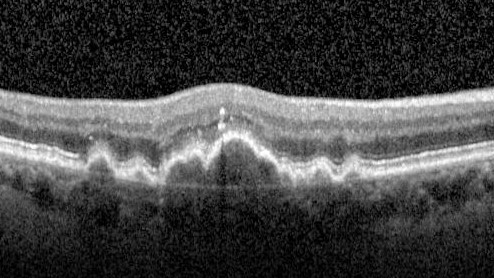 Focal Hyperpigmentation in Dry Age-Related Macular Degeneration
74 year old female with 20/32 vision right eye and 20/25 vision in the left eye.  Images show focal hyper-pigmentation which is a risk factor for progression to wet AMD
