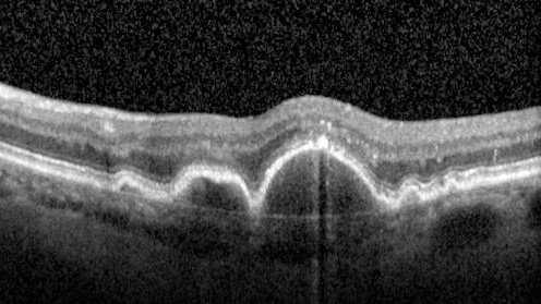 Focal Hyperpigmentation in Dry Age-Related Macular Degeneration
74 year old female with 20/32 vision right eye and 20/25 vision in the left eye.  Images show focal hyper-pigmentation which is a risk factor for progression to wet AMD
