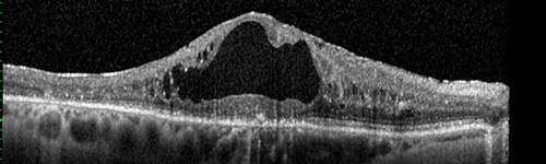 DRIL - Disorganization Retinal Inner Layers
Following treatment for BRVO vision stayed at 3/200 despite resolution of edema
