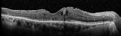 DRIL - Disorganization Retinal Inner Layers
Following treatment for BRVO vision stayed at 3/200 despite resolution of edema
