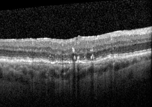 Pigment migration in dry age-related macular degeneration
80 year old female.  Dry AMD with GA in the left eye and pigment migration visible on OCT scan.
VA 20/40 OD, 20/160 OS
