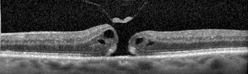 Stage II Macular Hole - PPV without ILM peel
77 year old man with 20/40 VA on presentation.  Macular hole did not abort and vision dropped to 20/63.  Post PPV vision was 20/25 within 6 months
