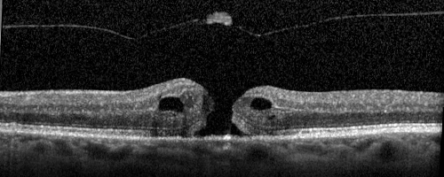 Stage II Macular Hole - PPV without ILM peel
77 year old man with 20/40 VA on presentation.  Macular hole did not abort and vision dropped to 20/63.  Post PPV vision was 20/25 within 6 months
