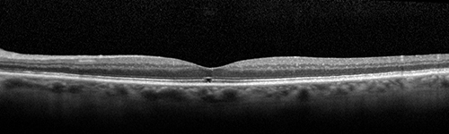 Stage II Macular Hole - PPV without ILM peel
77 year old man with 20/40 VA on presentation.  Macular hole did not abort and vision dropped to 20/63.  Post PPV vision was 20/25 within 6 months
