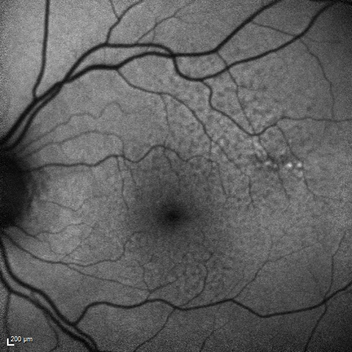 Reticular Macular Disease (Dry Macular Degeneration) - Fundus Autolfuorescence
85 year old woman with 20/25 vision OU and reticular macular disease
