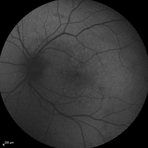 Macular Edema and dry AMD - excellent example of why FA and ICG are necessary in management of wet AMD
This 72 year old woman has an OCT that looks like wet AMD.  Only her FA and ICG show that she has inflammatory macular edema.  She had no clinical signs or symptoms of uveitis.  Nevertheless, the macular edema responded to subtenon's kenalog.
