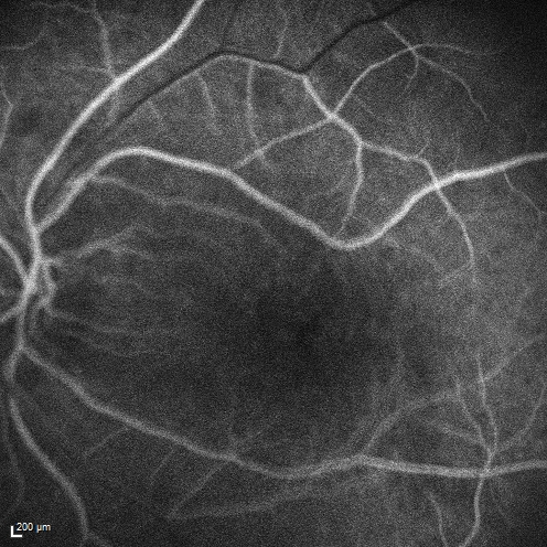 Macular Edema and dry AMD - excellent example of why FA and ICG are necessary in management of wet AMD
This 72 year old woman has an OCT that looks like wet AMD.  Only her FA and ICG show that she has inflammatory macular edema.  She had no clinical signs or symptoms of uveitis.  Nevertheless, the macular edema responded to subtenon's kenalog.
