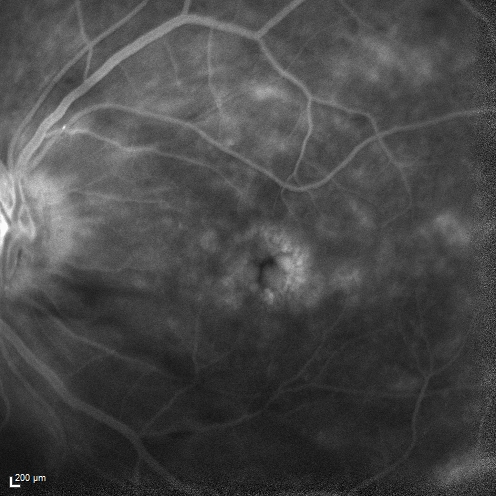 Macular Edema and dry AMD - excellent example of why FA and ICG are necessary in management of wet AMD
This 72 year old woman has an OCT that looks like wet AMD.  Only her FA and ICG show that she has inflammatory macular edema.  She had no clinical signs or symptoms of uveitis.  Nevertheless, the macular edema responded to subtenon's kenalog.
