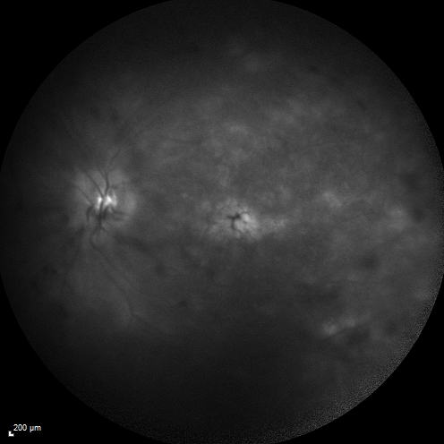 Macular Edema and dry AMD - excellent example of why FA and ICG are necessary in management of wet AMD
This 72 year old woman has an OCT that looks like wet AMD.  Only her FA and ICG show that she has inflammatory macular edema.  She had no clinical signs or symptoms of uveitis.  Nevertheless, the macular edema responded to subtenon's kenalog.
