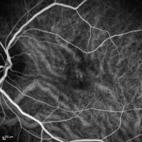 Macular Edema and dry AMD - excellent example of why FA and ICG are necessary in management of wet AMD
This 72 year old woman has an OCT that looks like wet AMD.  Only her FA and ICG show that she has inflammatory macular edema.  She had no clinical signs or symptoms of uveitis.  Nevertheless, the macular edema responded to subtenon's kenalog.
