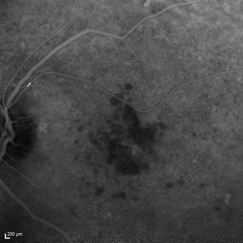 Macular Edema and dry AMD - excellent example of why FA and ICG are necessary in management of wet AMD
This 72 year old woman has an OCT that looks like wet AMD.  Only her FA and ICG show that she has inflammatory macular edema.  She had no clinical signs or symptoms of uveitis.  Nevertheless, the macular edema responded to subtenon's kenalog.

