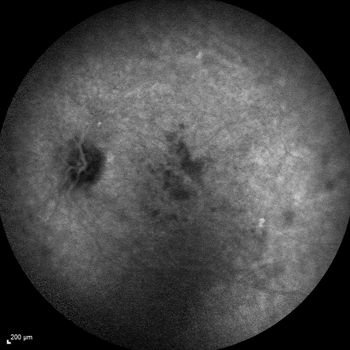 Macular Edema and dry AMD - excellent example of why FA and ICG are necessary in management of wet AMD
This 72 year old woman has an OCT that looks like wet AMD.  Only her FA and ICG show that she has inflammatory macular edema.  She had no clinical signs or symptoms of uveitis.  Nevertheless, the macular edema responded to subtenon's kenalog.
