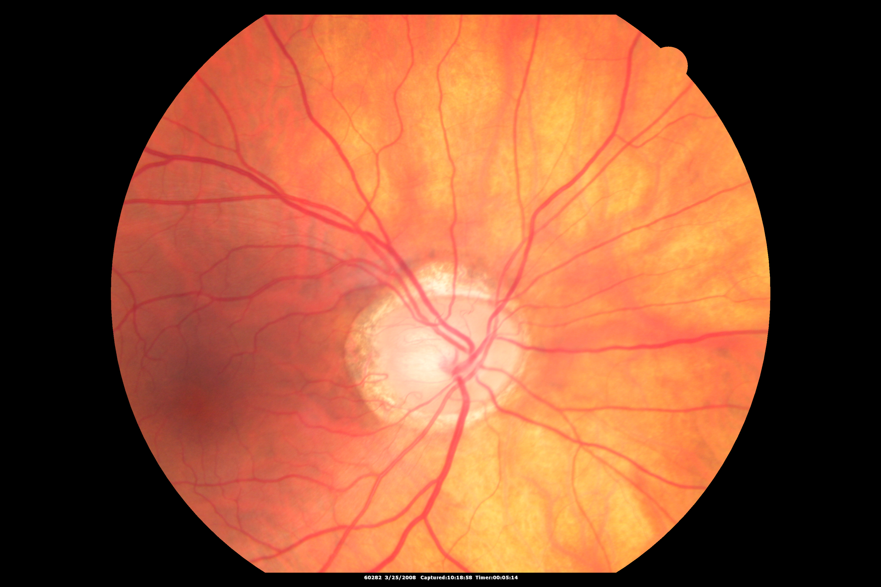 Ангиопатия сосудов сетчатки что это. Диабетическая ретинопатия сетчатки. Диабетическая ретинопатия глазное дно. Пролиферативная диабетическая ретинопатия. Препролиферативная диабетическая ретинопатия глазное дно.