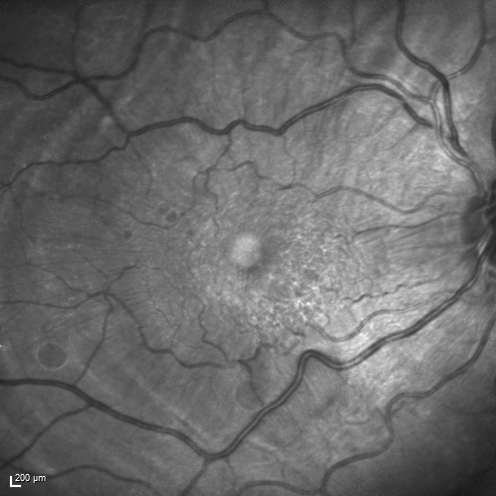 Choroidal Folds Hyperope (+5.00)
