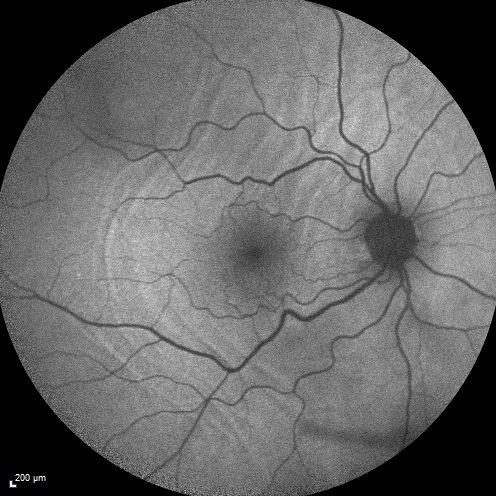 Choroidal Folds Hyperope (+5.00)
