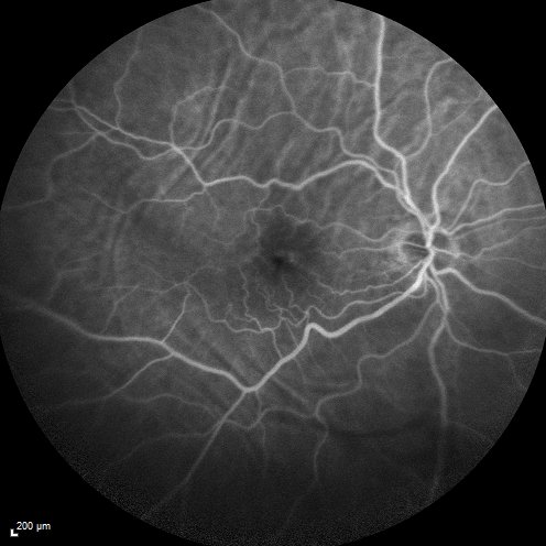 Choroidal Folds Hyperope (+5.00)
