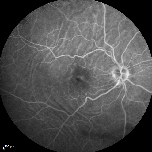 Choroidal Folds Hyperope (+5.00)
