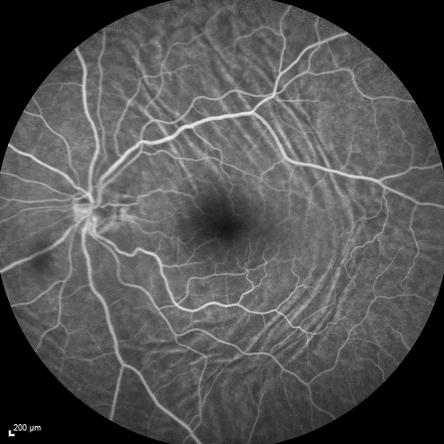 Choroidal Folds Hyperope (+5.00)

