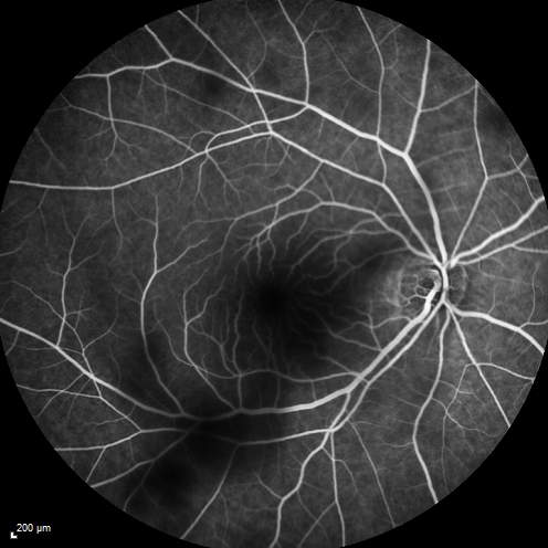 Cystoid Macular Edema 10 years after Cataract Surgery
No overt uveitis but the patient had aching in the eyes and responded to topical anti-inflammatory drops with recurrence of the CME on discontinuation of topical therapy
