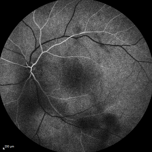 Cystoid Macular Edema 10 years after Cataract Surgery
No overt uveitis but the patient had aching in the eyes and responded to topical anti-inflammatory drops with recurrence of the CME on discontinuation of topical therapy
