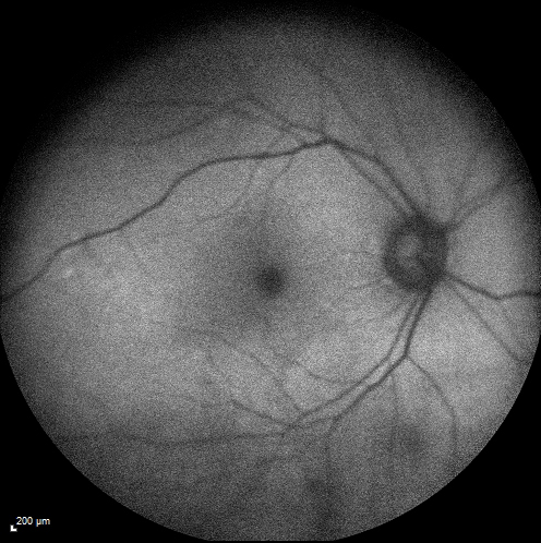 Cystoid macular edema 4 months following cataract surgery with serous retinal detachment
68 year old with 2 months of vision loss OS 20/100.  ECCE was 4 months ago.
