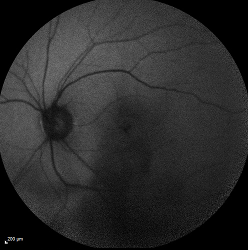Cystoid macular edema 4 months following cataract surgery with serous retinal detachment
68 year old with 2 months of vision loss OS 20/100.  ECCE was 4 months ago.
