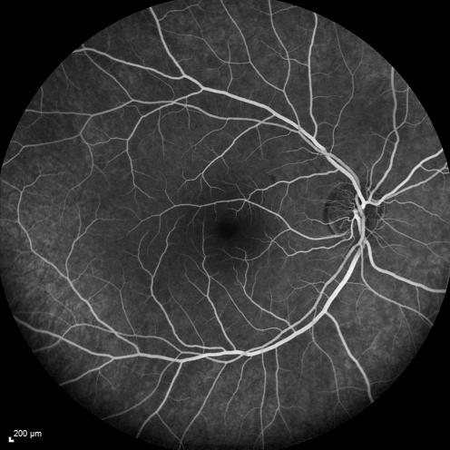 Central retinal artery and vein occlusion - Protein C Deficiency 33 year old male
33 year old male with vision loss for 3 hours.  VA 20/12 right eye, 5/200 left eye.  He has a protein C deficiency.  The left eye recovered vision in about 1 month to 20/16.  FA shows very slow recirculation time.
