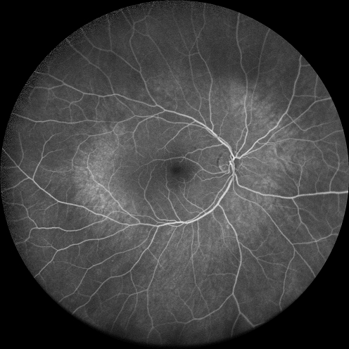 Central retinal artery and vein occlusion - Protein C Deficiency 33 year old male
33 year old male with vision loss for 3 hours.  VA 20/12 right eye, 5/200 left eye.  He has a protein C deficiency.  The left eye recovered vision in about 1 month to 20/16.  FA shows very slow recirculation time.
