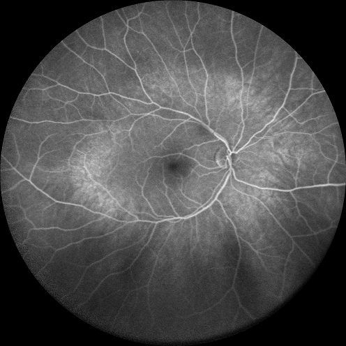 Central retinal artery and vein occlusion - Protein C Deficiency 33 year old male
33 year old male with vision loss for 3 hours.  VA 20/12 right eye, 5/200 left eye.  He has a protein C deficiency.  The left eye recovered vision in about 1 month to 20/16.  FA shows very slow recirculation time.
