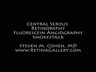 Acute Central Serous Retinopathy - Classic Smokestack on Fluorescein Angiogram - Antimated .GIF
34-year-old man noticed about five days ago decreased vision in the right eye.  He was having difficulty playing video games and seeing with that eye.  He thought maybe his refractive error was shifting.  
VISUAL ACUITY:  Vision OD is 20/40, OS is 20/16
