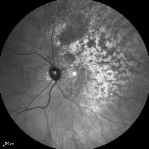 Equatorial Drusen
61 year old female with normal visoin
