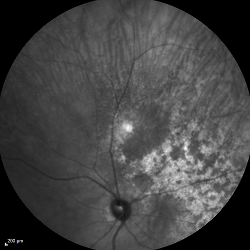 Equatorial Drusen
61 year old female with normal visoin
