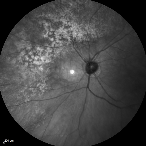 Equatorial Drusen
61 year old female with normal visoin
