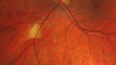 Focal Scleral Nodule
49 year old white female with recent mild trauma to the right eye and 20/20 vision in both eyes.  Left eye has a focal scleral nodule
