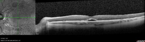 Persistent subfoveal fluid following retinal detachment repair
62 year old man following pneumatic retinopexy for macula-off retinal detachment.  Subfoveal fluid persisted for more than a year.
