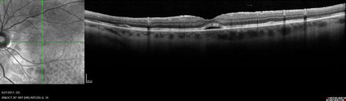 Persistent subfoveal fluid following retinal detachment repair
62 year old man following pneumatic retinopexy for macula-off retinal detachment.  Subfoveal fluid persisted for more than a year.
