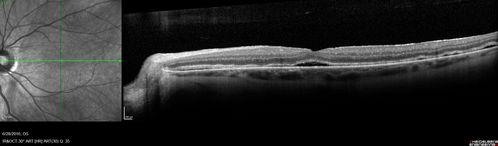 Persistent subfoveal fluid following retinal detachment repair
62 year old man following pneumatic retinopexy for macula-off retinal detachment.  Subfoveal fluid persisted for more than a year.
