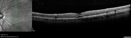 Persistent subfoveal fluid following retinal detachment repair
62 year old man following pneumatic retinopexy for macula-off retinal detachment.  Subfoveal fluid persisted for more than a year.
