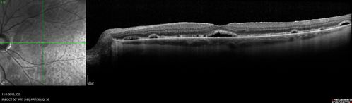 Persistent subfoveal fluid following retinal detachment repair
62 year old man following pneumatic retinopexy for macula-off retinal detachment.  Subfoveal fluid persisted for more than a year.
