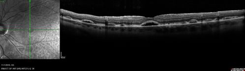 Persistent subfoveal fluid following retinal detachment repair
62 year old man following pneumatic retinopexy for macula-off retinal detachment.  Subfoveal fluid persisted for more than a year.
