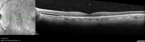 Persistent subfoveal fluid following retinal detachment repair
62 year old man following pneumatic retinopexy for macula-off retinal detachment.  Subfoveal fluid persisted for more than a year.
