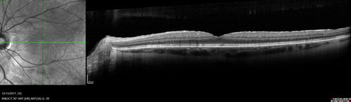 Persistent subfoveal fluid following retinal detachment repair
62 year old man following pneumatic retinopexy for macula-off retinal detachment.  Subfoveal fluid persisted for more than a year.
