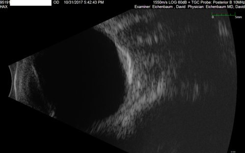 Choroidal Osteoma - 13 year old - Good Vision 20-40 - B-scan Ultrasound
