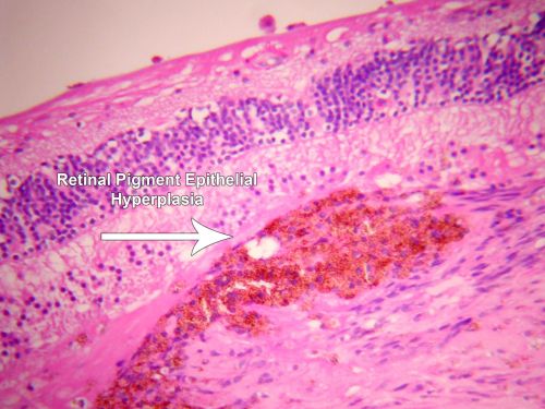 Macular Scar with Retinal Pigment Epithelial Hyperplasia - Hyperpigmentation - Wet Macular Degeneration
Macular Scar in age related macular degeneration with pathology showing retinal pigment epithelial hyperplasia at the edge of the scar.  Histopathogy, microscopic slide, pathology.
