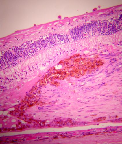 Macular Scar with Retinal Pigment Epithelial Hyperplasia - Hyperpigmentation - Wet Macular Degeneration
Macular Scar in age related macular degeneration with pathology showing retinal pigment epithelial hyperplasia at the edge of the scar.  Histopathogy, microscopic slide, pathology.
