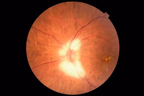 Myelinated Nerve Fiber Layer - Optic Nerve
Right eye subtle and inferior - left eye obvious
