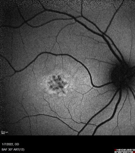 ABCA4 positive - Stargardt Disease
24 year old female She has worn glasses since she was a kid.  Since she became an adult her vision started to deteriorate more rapidly.  This seems to have been happening since she entered the accounting department for the last two years.  Her vision is worse in the light especially when she is driving.  She can see green lights in the night but not in the day.  She sees better on a dark background than on a light background. 
Her mother and father both have inherited retinal diseases.  His mother was diagnosed 23 years ago with Stargardts genetically confirmed in Boston.  The father has Retinitis Pigmentosa.  The mother has seven brothers and sisters and four have Stargardts and they are legally blind.  Also one cousin has it.

PMHx benign, Meds: vitamins.
VA OD: Dcc20/160
VA OS: Dcc20/160
IOP: TP: OD:20 OS:21
